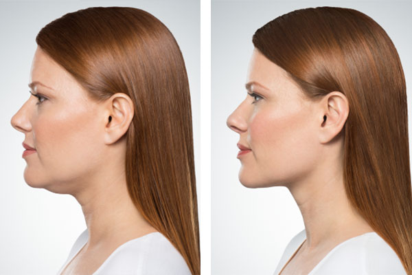 Spa Bella Denver skin care | Kybella