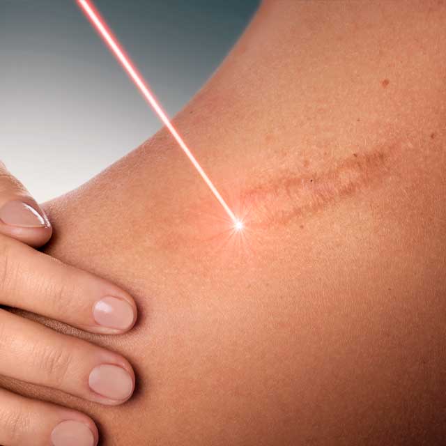 Laser skin treatment