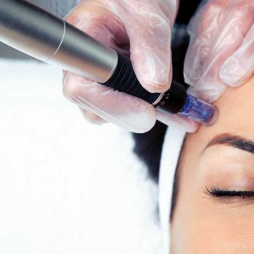 Woman getting microneedling treatment