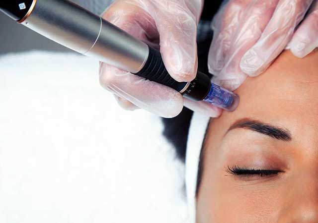 Woman getting microneedling