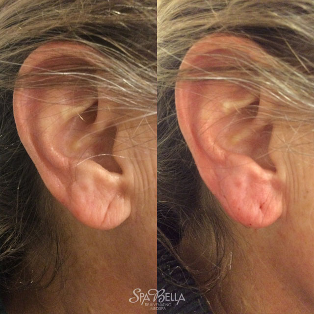 Vollure Earlobe Before & After