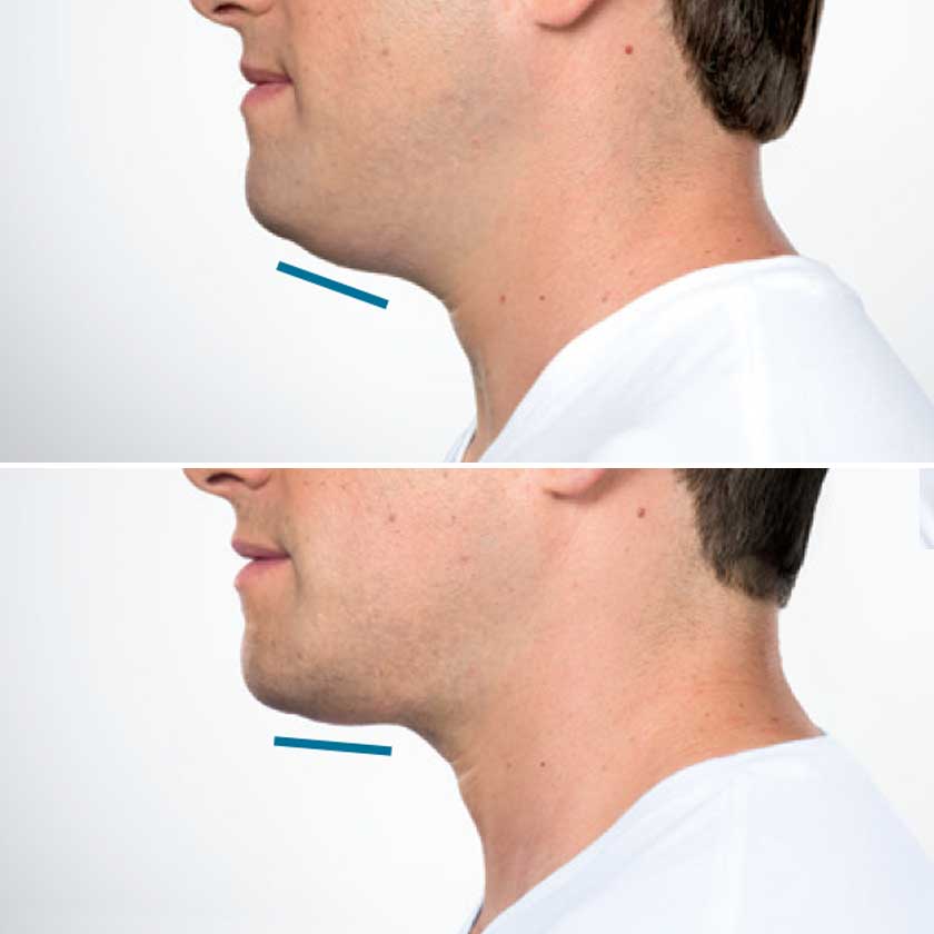 Kybella Before and After
