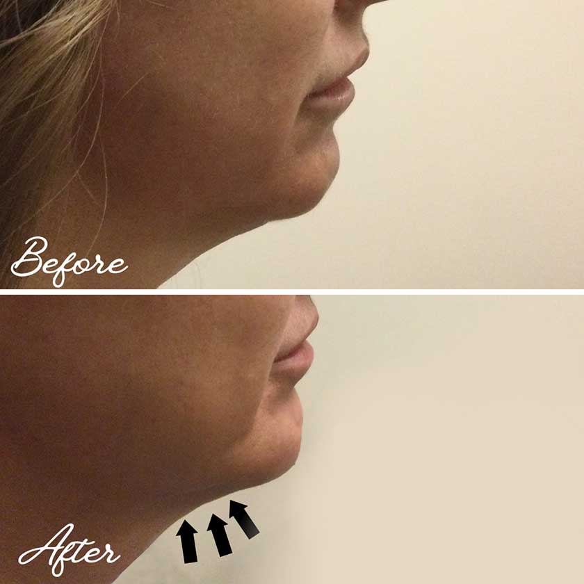 Kybella Before & After