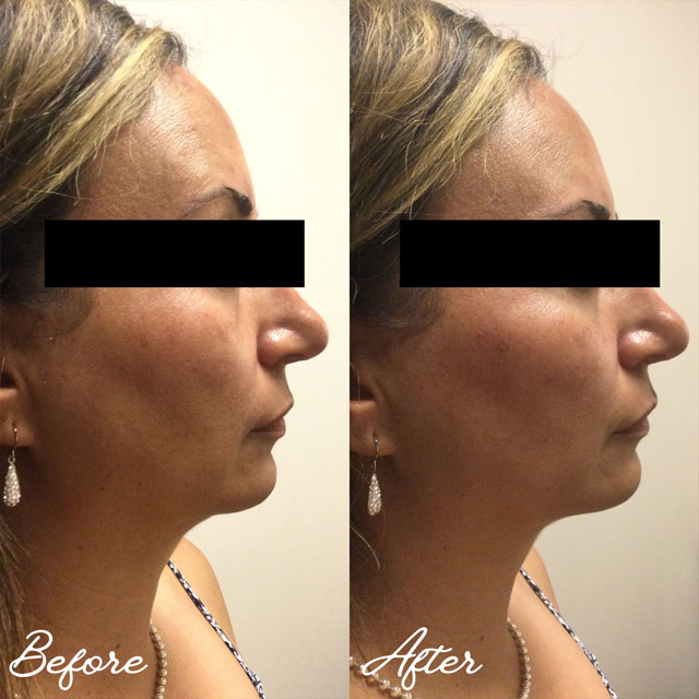 Voluma Cheeks Before and After