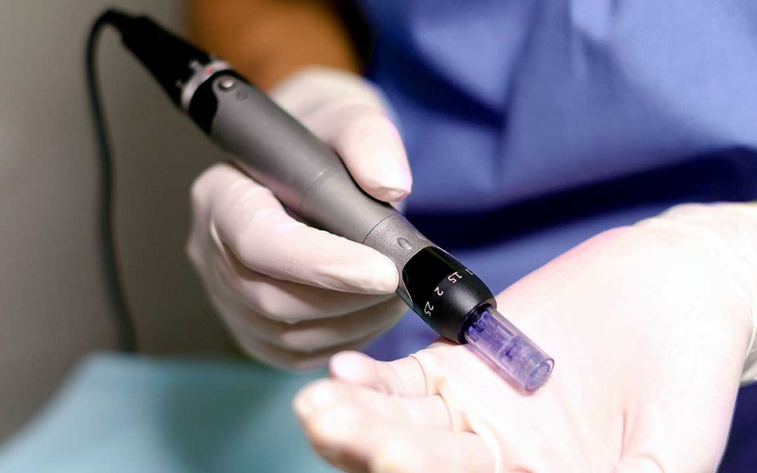 Microneedling tool used for Vampire Facial