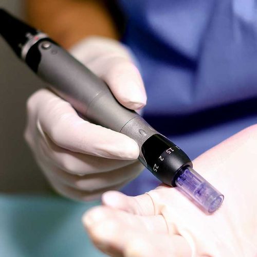 Microneedling tool used for Vampire Facial