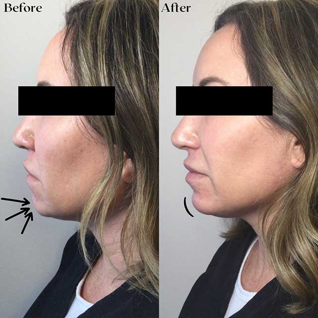 Voluma Chin Before & After