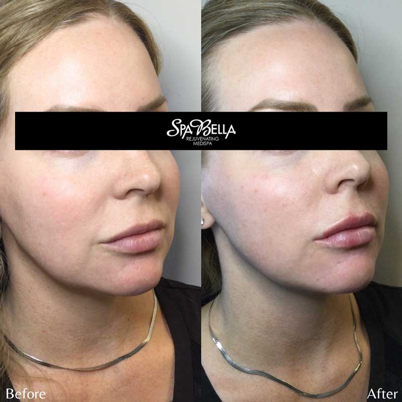 Juvederm Filler in Nasolabial Folds