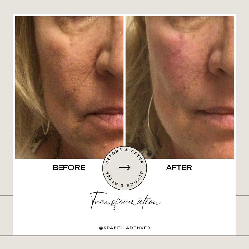 Nasolabial Fold Filler