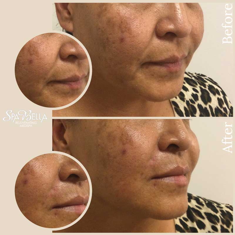 Vollure Nasolabial Fold Filler