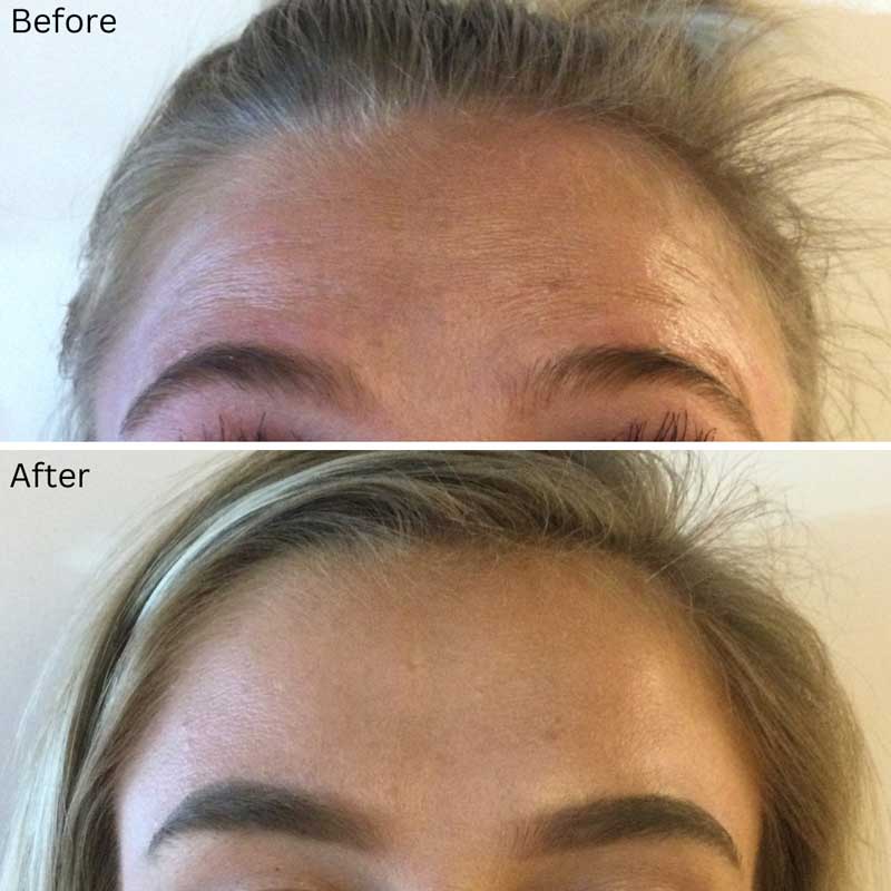 Botox - Before & After