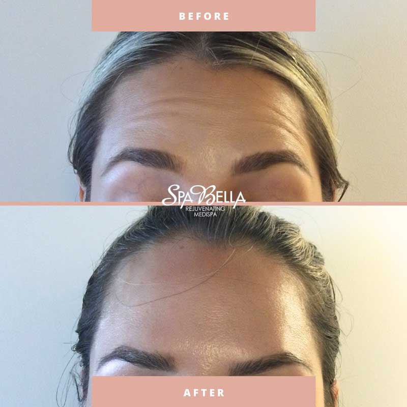 Botox - Before & After