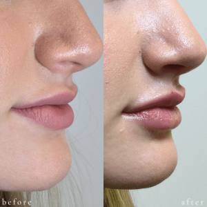 Before and After Lip Treatment