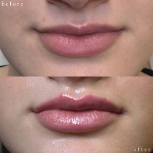 Before and After Lip Treatment