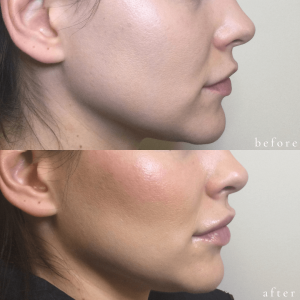 Before and After Filler
