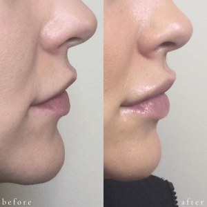 Before and After Lip Filler