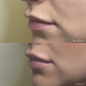 Before and After Filler