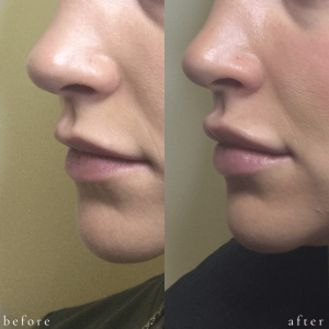 Before and After Filler