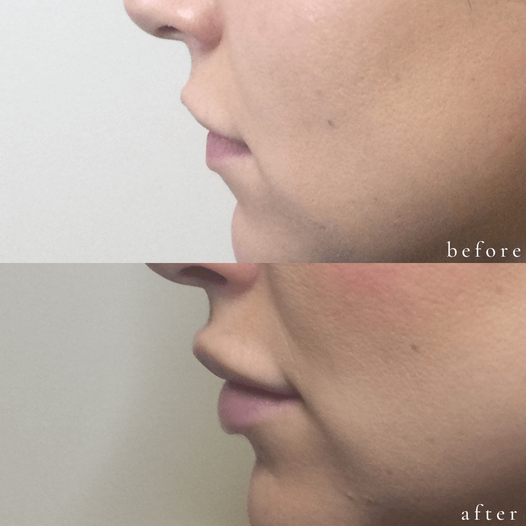 Juvederm Filler in Nasolabial Folds