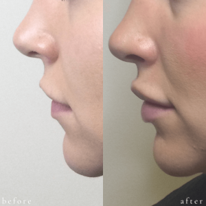Before and After Filler