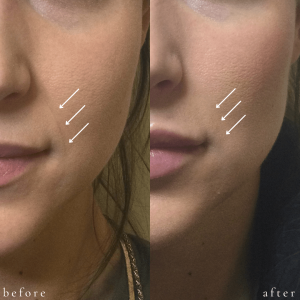 Before and After Filler