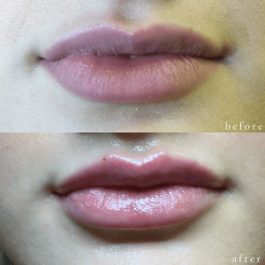 Before and After Lip Treatment