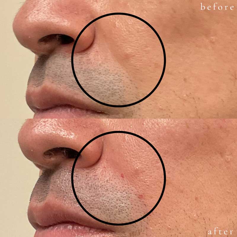 Vollure for Nasolabial Folds