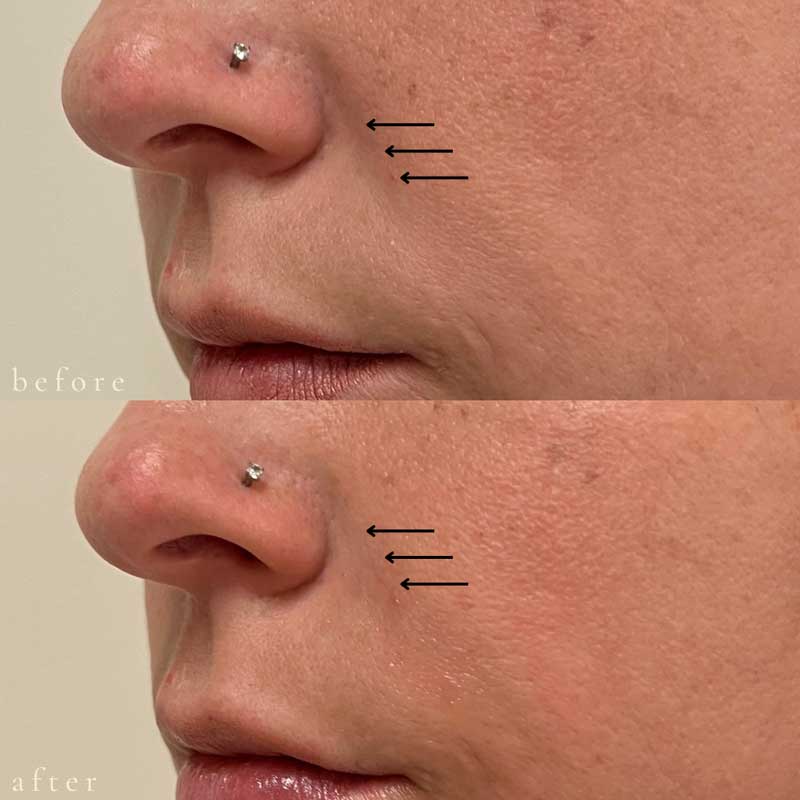 Vollure for Nasolabial Folds