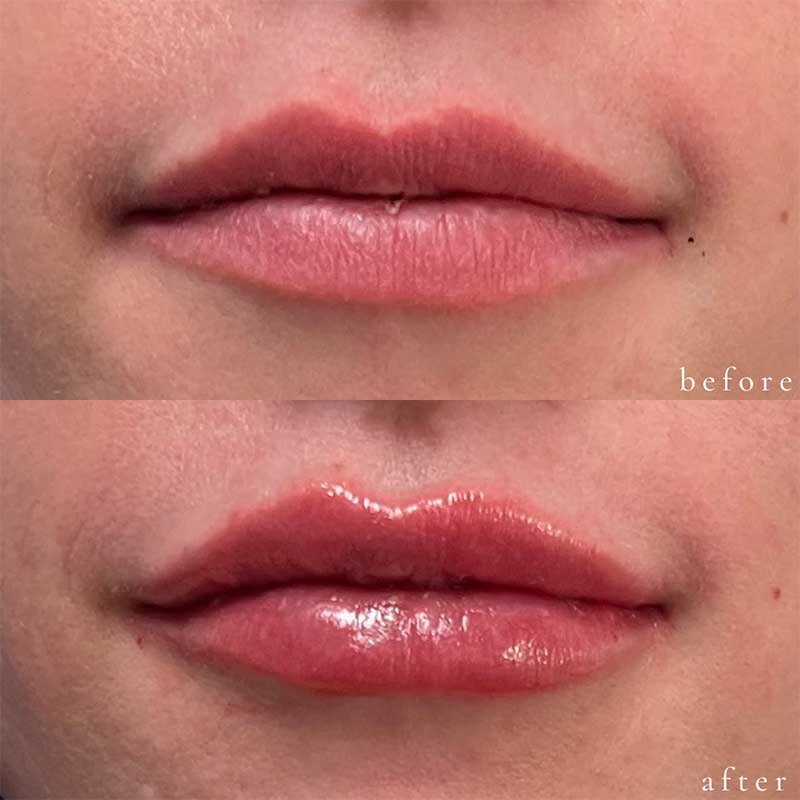 Lip Filler