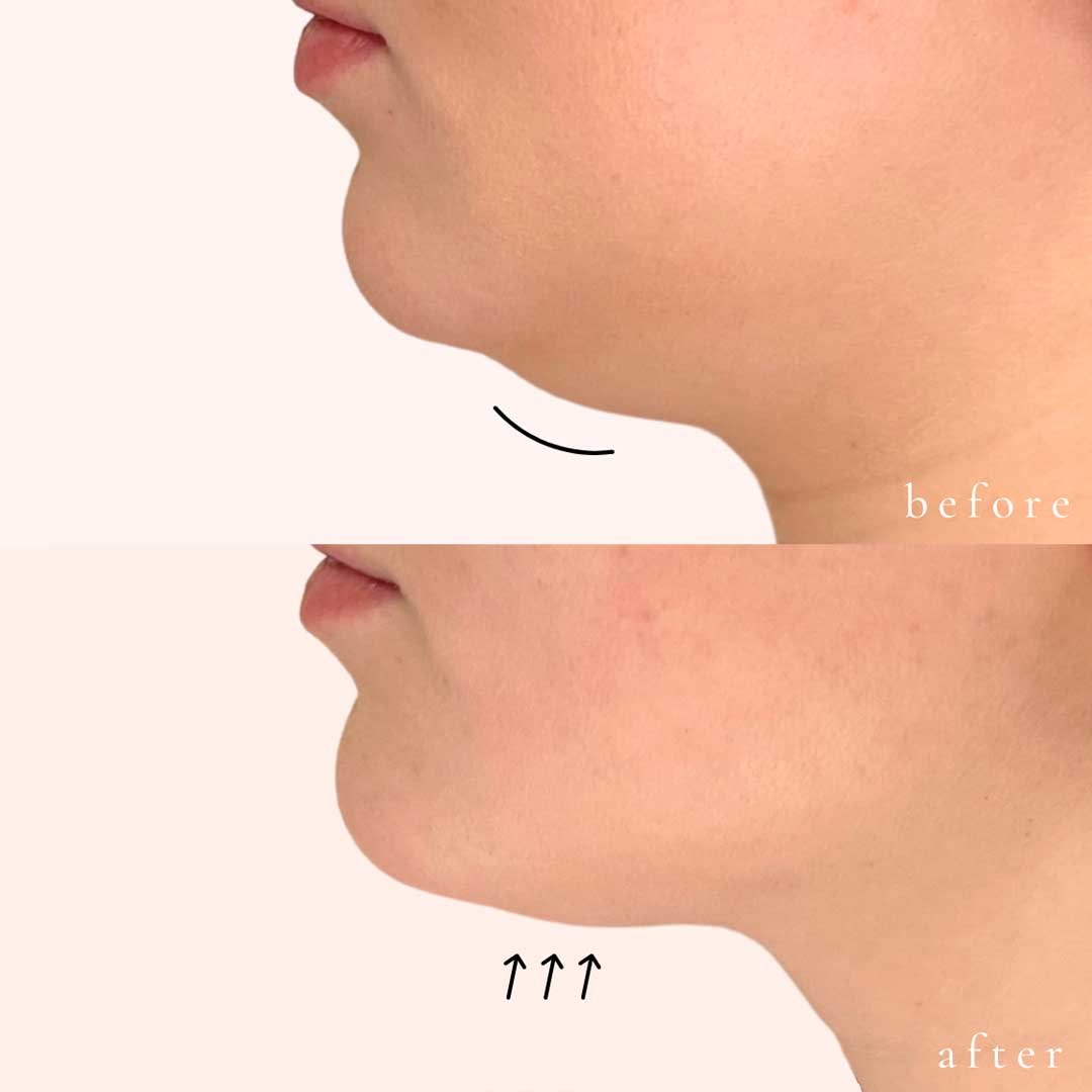 Kybella Before & After