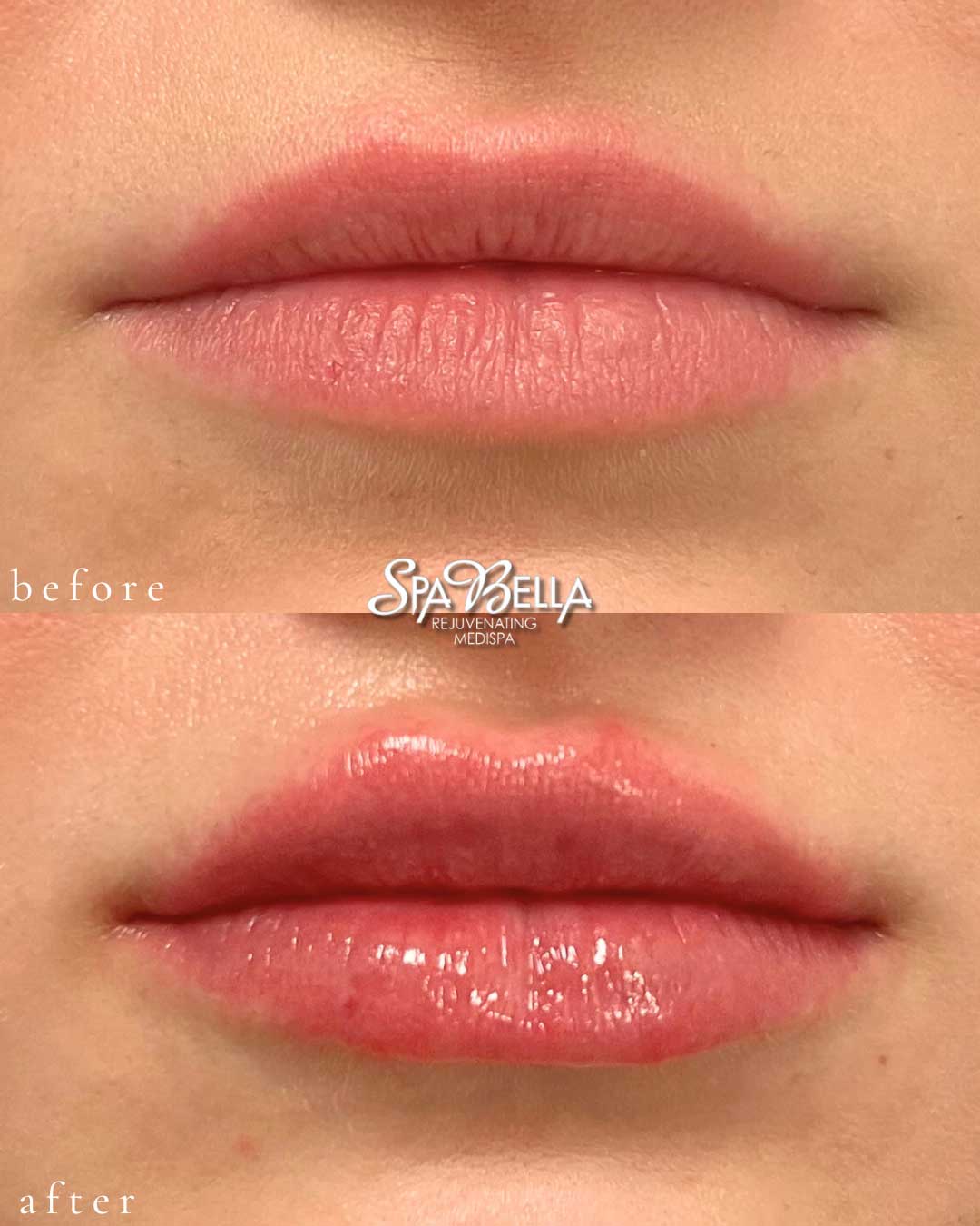 Lips - Before and After