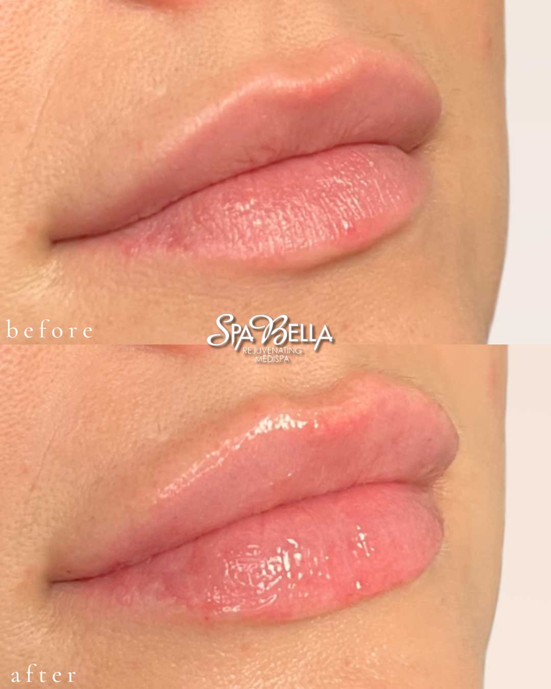 Lips - Before and After