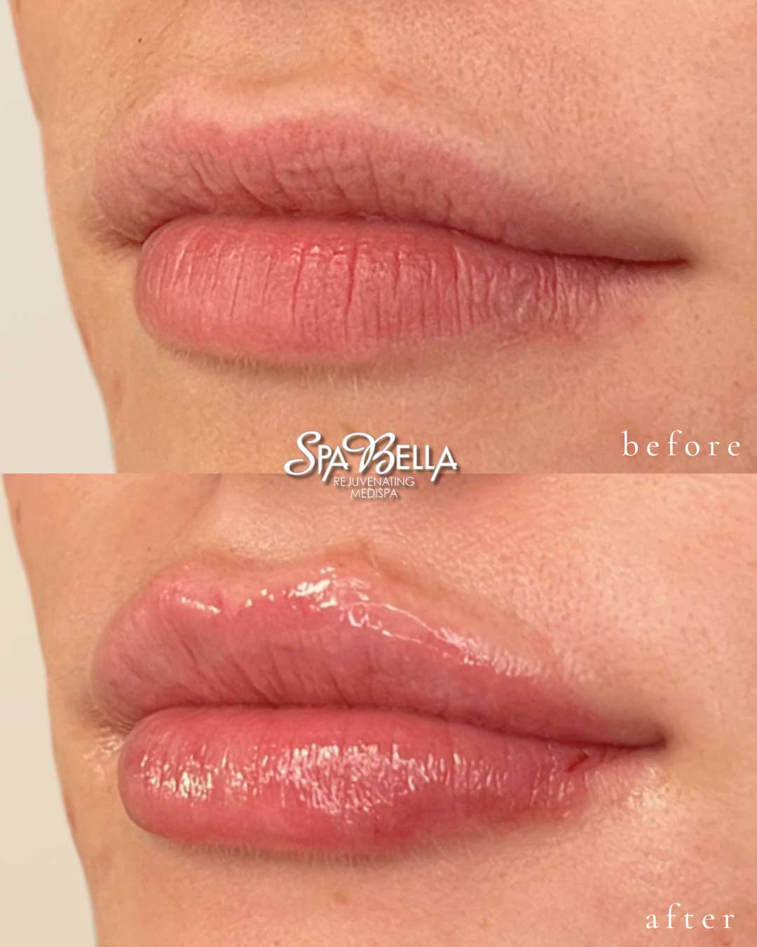 Lips - Before and After