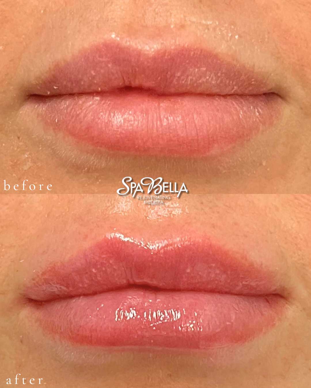 Lips - Before and After