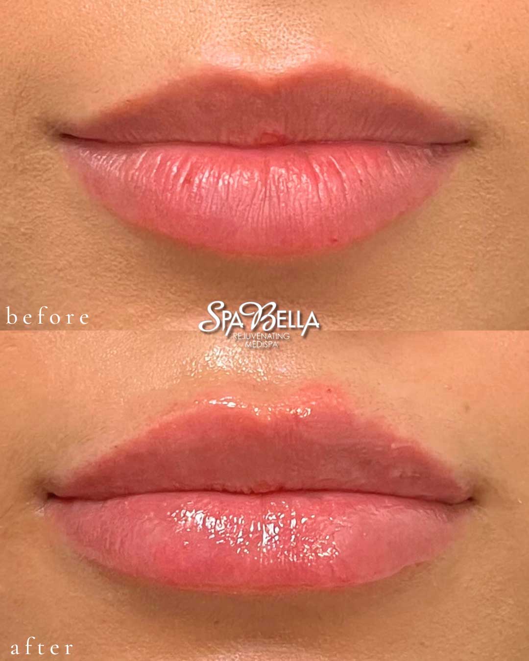 Lips - Before and After