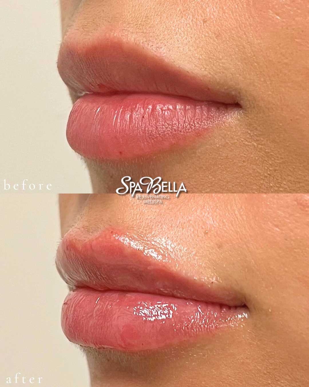 Lips - Before and After