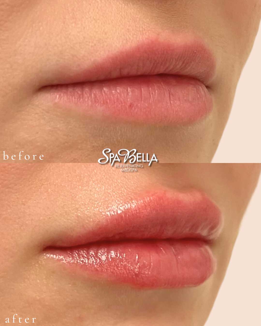 Lips - Before and After