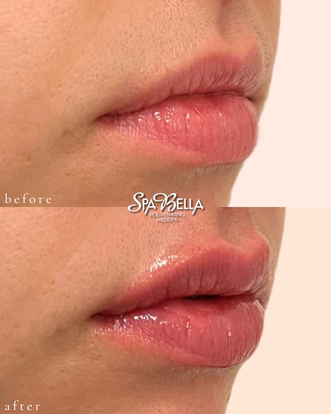 Lips - Before and After