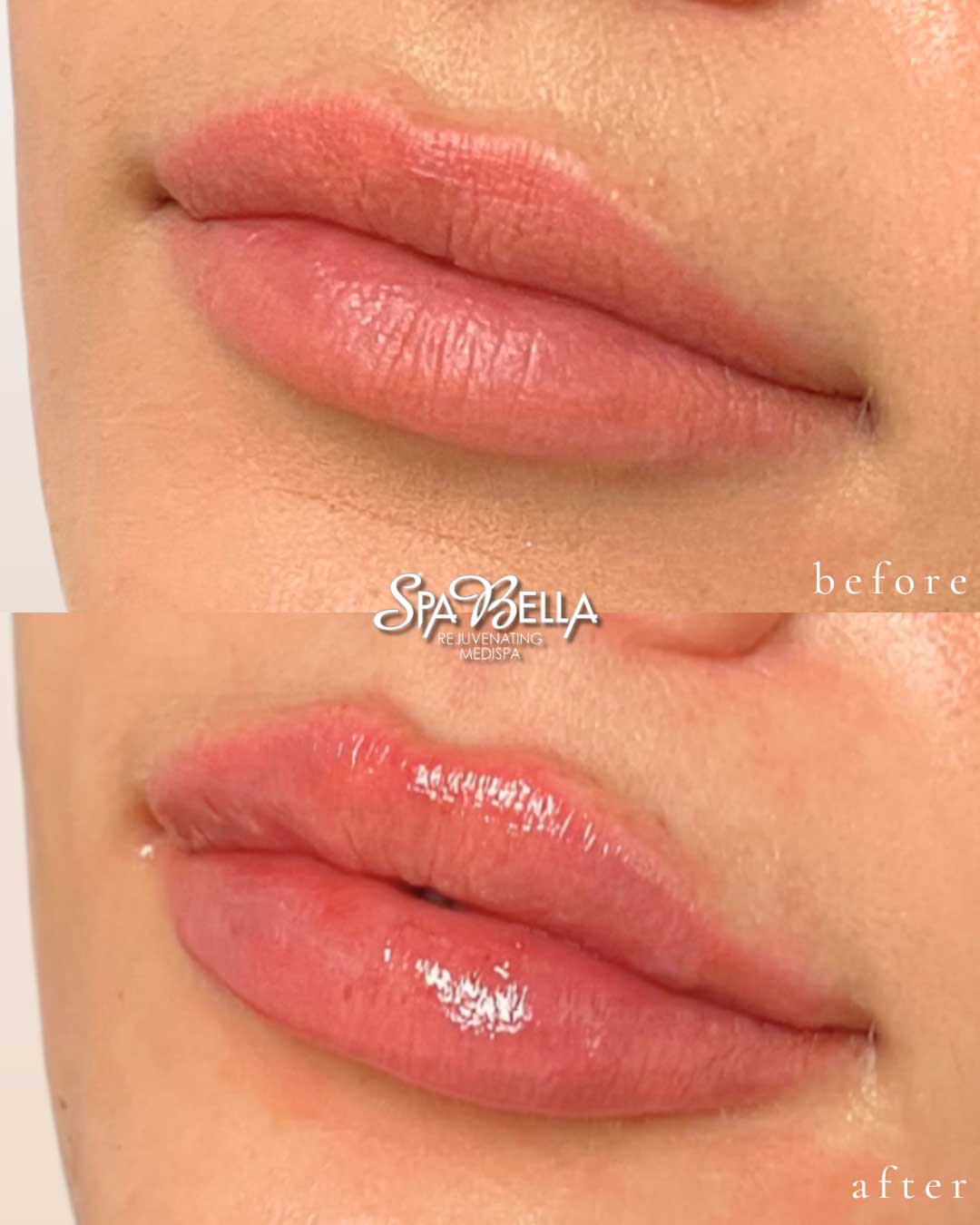 Lips - Before and After