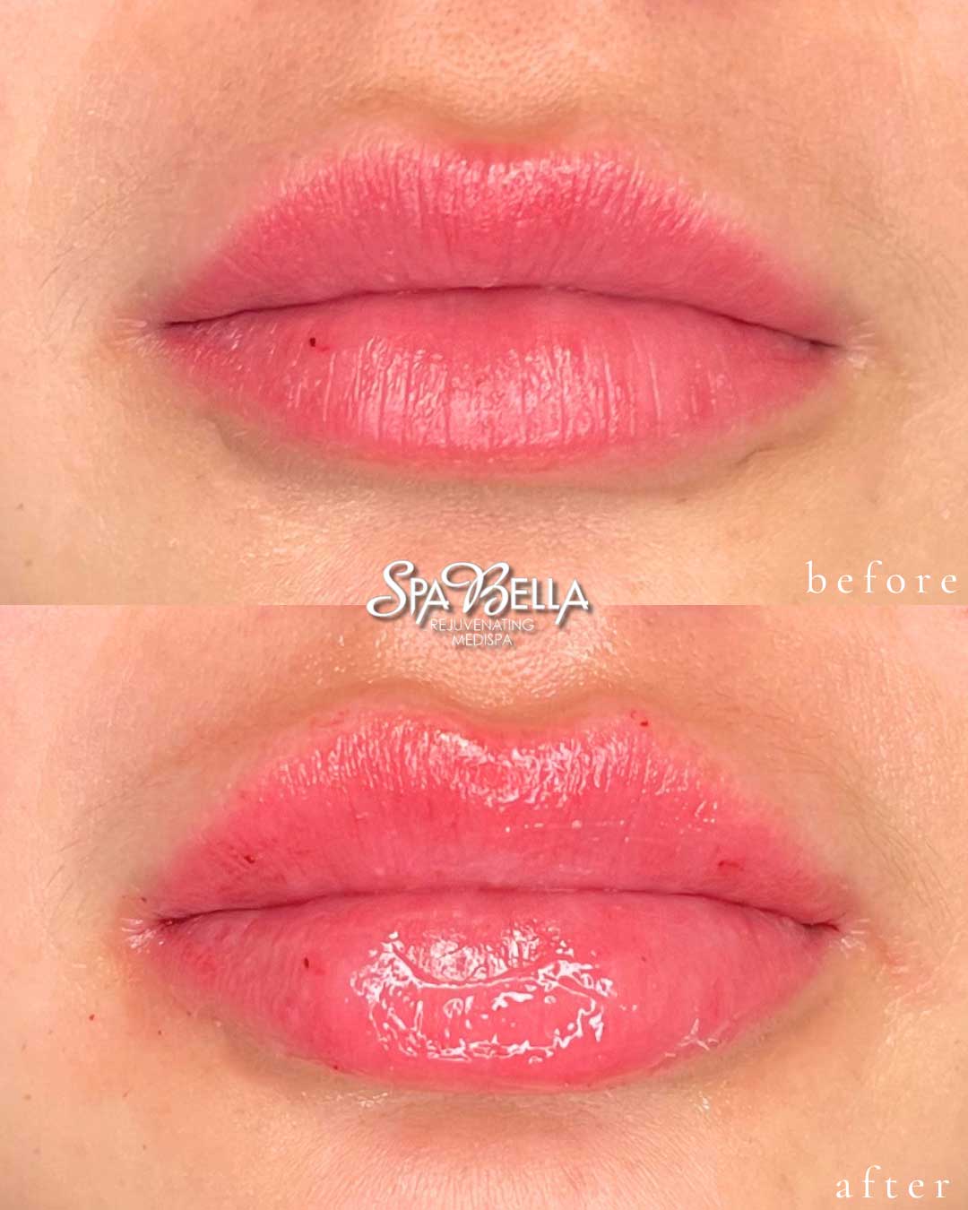 Lips - Before and After