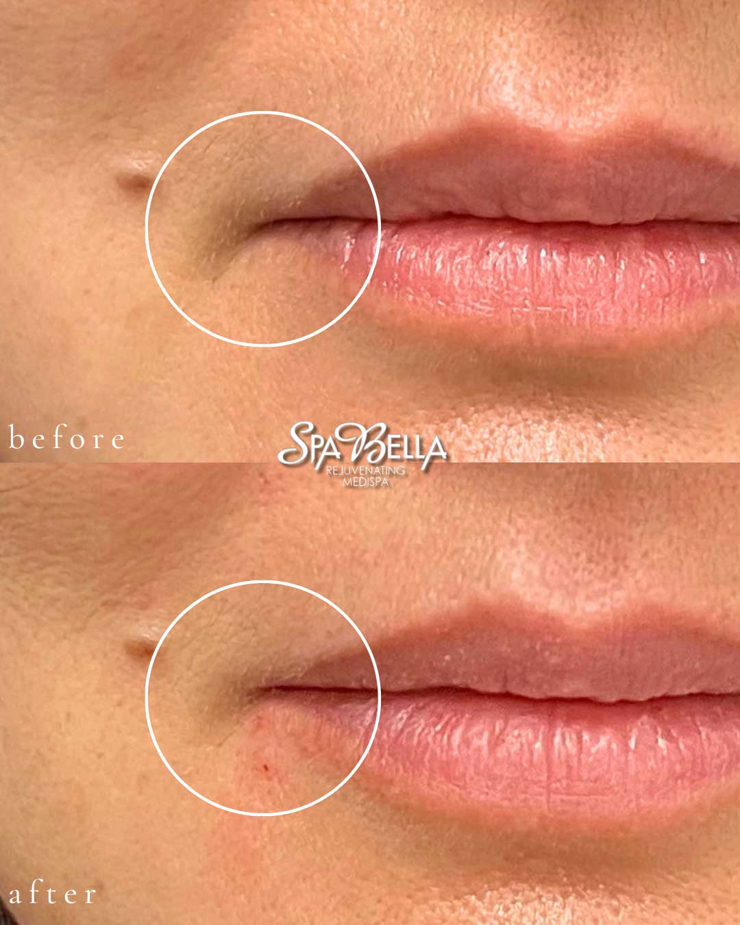 Lips - Before and After