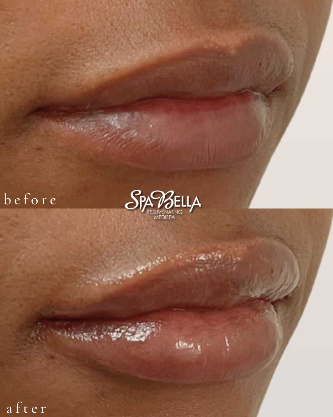 Lips - Before and After