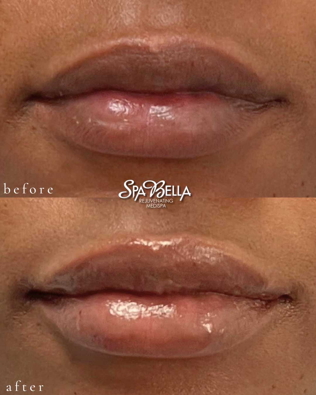 Lips - Before and After